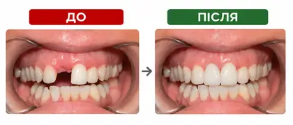Заміна втраченого зуба мостоподібною конструкцією з діоксиду циркону. Матеріал має високу міцність та естетичність, що дозволяє відновити функцію та естетику. Використовується як альтернатива імплантації при відсутності кількох зубів.