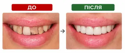 Перевтілення посмішки за допомогою металокерамічних коронок Зміна форми та кольору передніх зубів за допомогою коронок з металокераміки